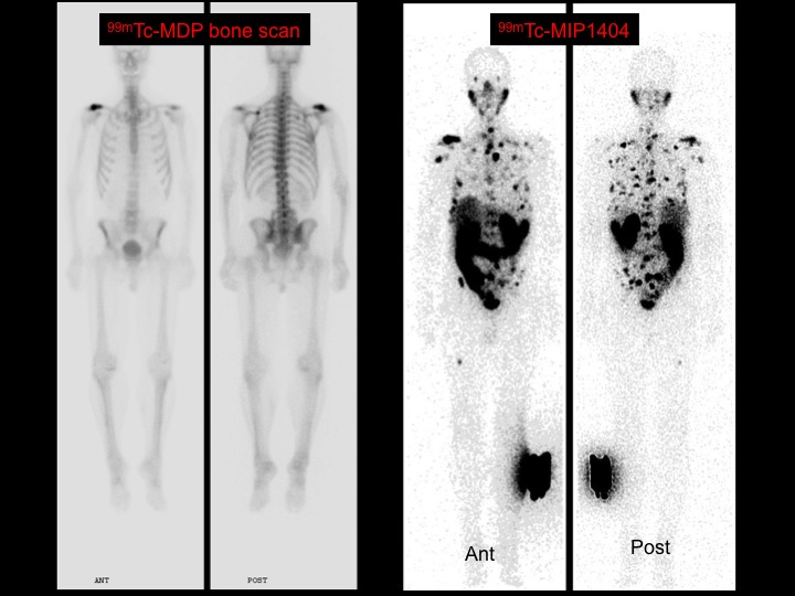 Lutetium 177 Psma Therapy